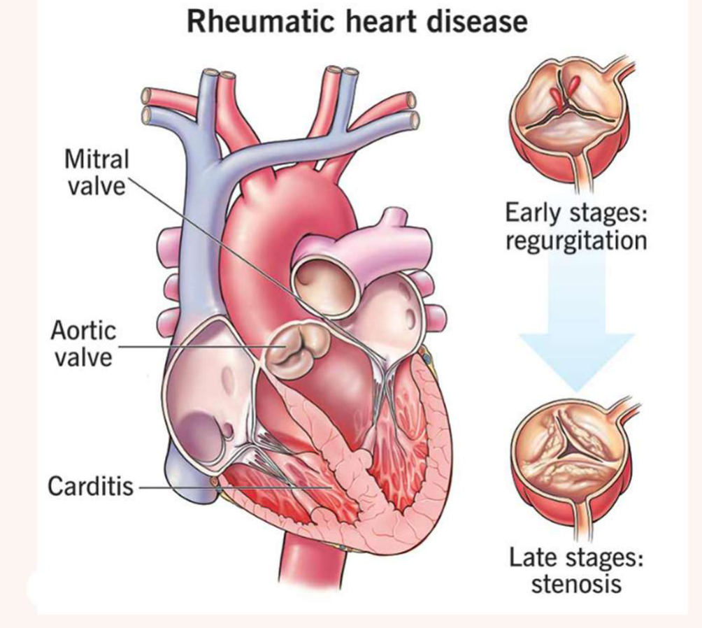 Rheumatic heart disease
