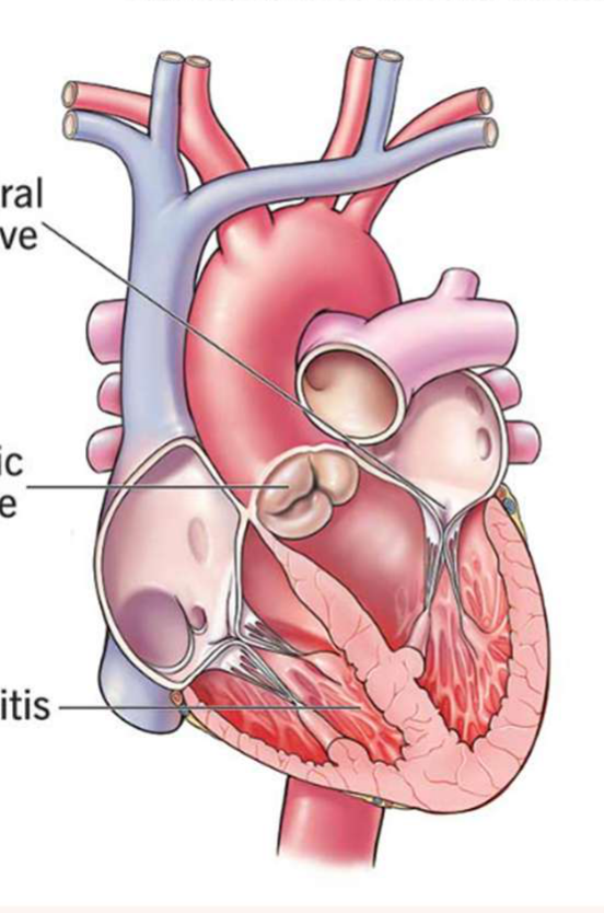 Late stages: stenosis