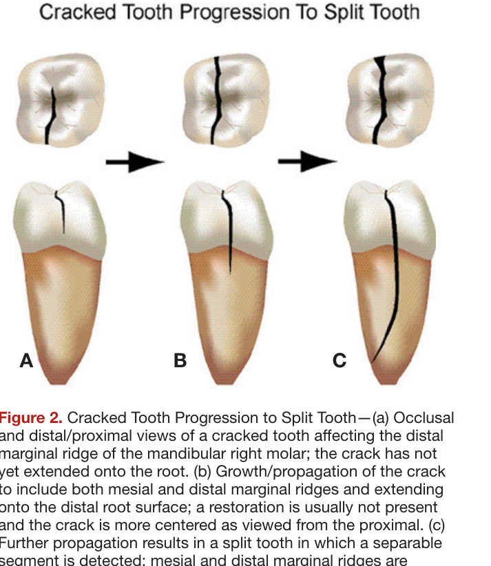Figure 2. Cracked Tooth Progression To Split Tooth—(a) Occlusal and distal/proximal views of a cracked tooth affecting the distal marginal ridge of the mandibular right molar; the crack has not yet extended onto the root. (b) Growth/propagation of the crack to include both mesial and distal marginal ridges and extending onto the distal root surface; a restoration is usually not present and the crack is more centered as viewed from the proximal. (c) Further propagation results in a split tooth in which a separable segment is detected; mesial and distal marginal ridges are involved and the fracture extends deeply in the root.