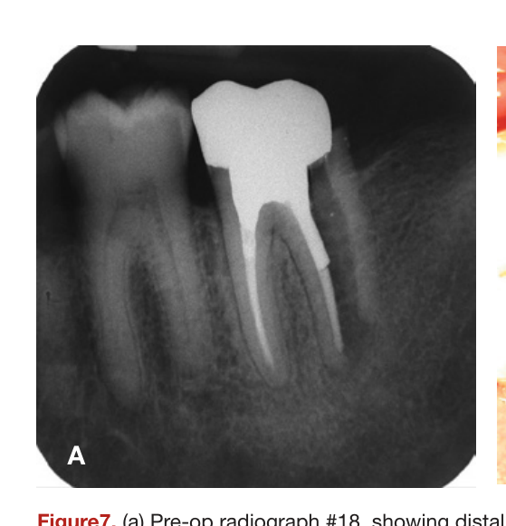 Figure7. (a) Pre-op radiograph #18, showing distal root fracture. (b) Post-op showing distal root hemisection. (c) 1 year recall showing complete healing. (Courtesy of Dr. Gary Matt)