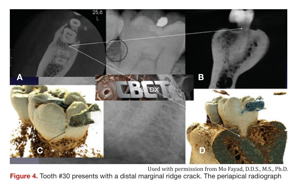 Figure 4. Tooth #30 presents with a distal marginal ridge crack. The periapical radiograph demonstrated normal distal root bone pattern and periodontal probings were within normal limits (WNL). (a) Axial CBCT view demonstrating the distal bony changes adjacent to the distal marginal ridge crack. (b) CBCT DICOM images imported into e-VolDX software and utilizing the fracture filter. The distal marginal ridge crack extending below the CEJ can be visualized. (c and d) Applying the realistic rendering function and visualizing the distal marginal ridge crack extension as well as the early distal bony changes adjacent to distal marginal ridge crack. All views confirm that the distal marginal ridge crack has extended below the CEJ. (Courtesy Dr. Mo Fayad)