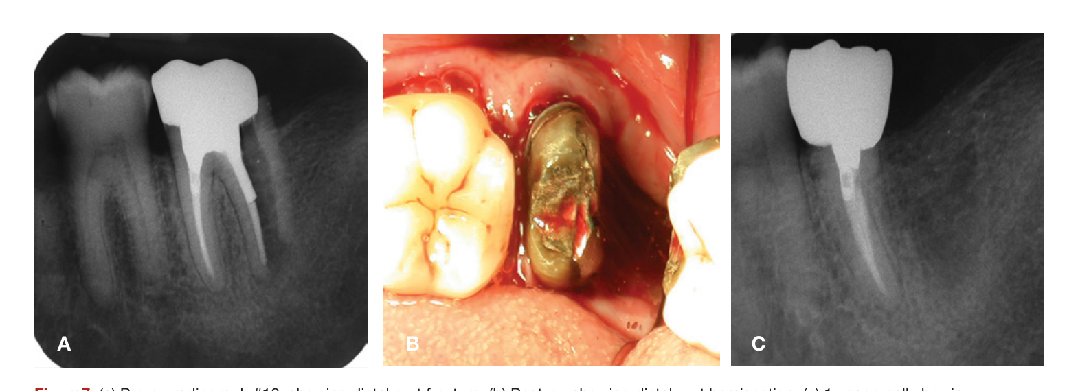 Figure7. (a) Pre-op radiograph #18, showing distal root fracture. (b) Post-op showing distal root hemisection. (c) 1 year recall showing complete healing. (Courtesy of Dr. Gary Matt)