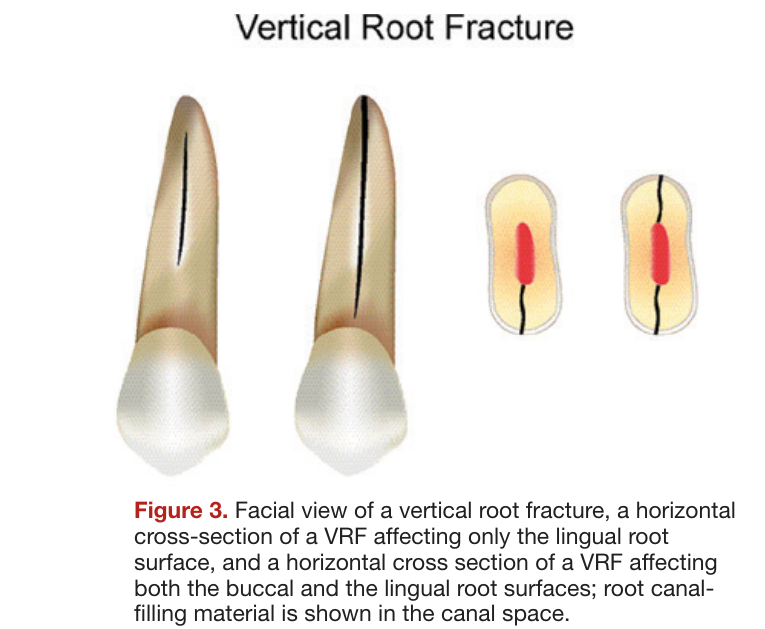 Figure 3. Facial view of a vertical root fracture, a horizontal cross-section of a VRF affecting only the lingual root surface, and a horizontal cross section of a VRF affecting both the buccal and the lingual root surfaces; root canal-filling material is shown in the canal space.