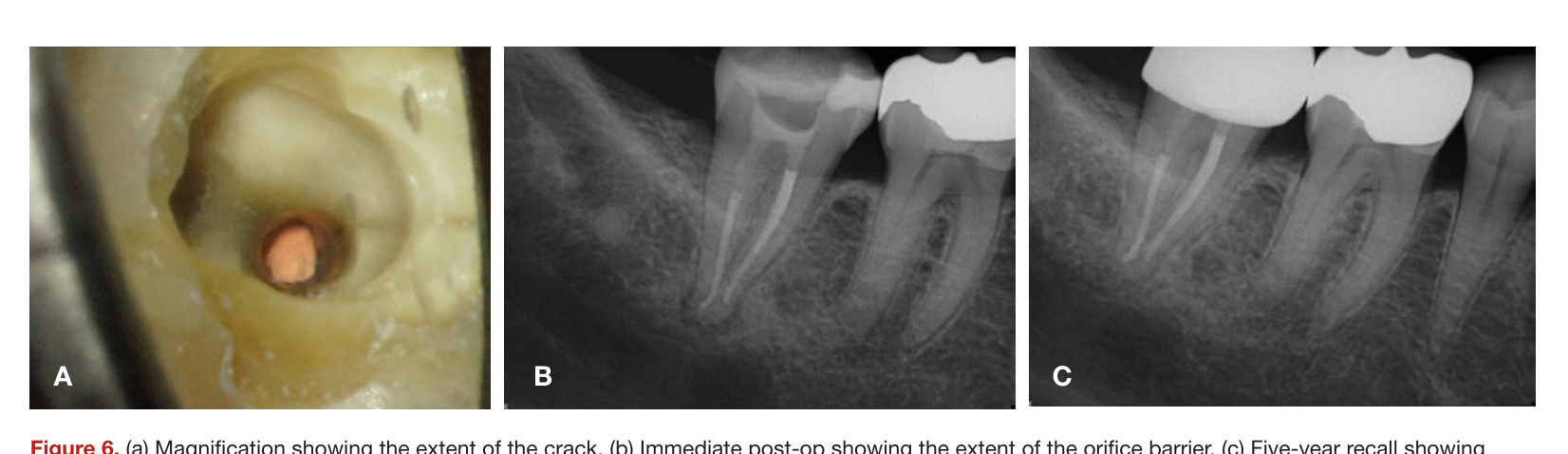 Figure 6. (a) Magnification showing the extent of the crack. (b) Immediate post-op showing the extent of the orifice barrier. (c) Five-year recall showing complete healing. (Courtesy of Dr. Matt Davis)