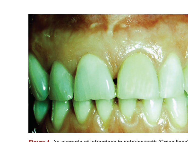 Figure 1. An example of Infractions in anterior teeth (Craze lines)