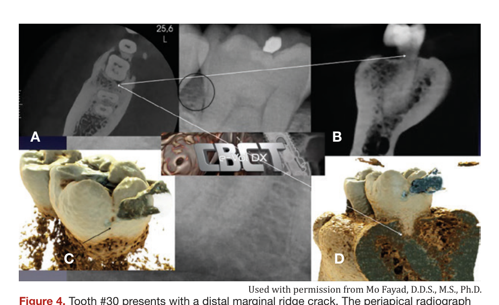 Figure 4. Tooth #30 presents with a distal marginal ridge crack. The periapical radiograph demonstrated normal distal root bone pattern and periodontal probings were within normal limits (WNL). (a) Axial CBCT view demonstrating the distal bony changes adjacent to the distal marginal ridge crack. (b) CBCT DICOM images imported into e-VolDX software and utilizing the fracture filter. The distal marginal ridge crack extending below the CEJ can be visualized. (c and d) Applying the realistic rendering function and visualizing the distal marginal ridge crack extension as well as the early distal bony changes adjacent to distal marginal ridge crack. All views confirm that the distal marginal ridge crack has extended below the CEJ. (Courtesy Dr. Mo Fayad)