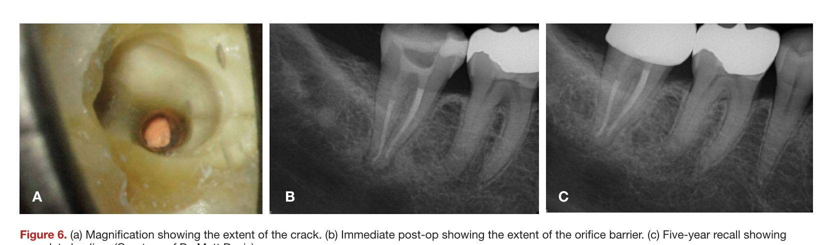 Figure 6. (a) Magnification showing the extent of the crack. (b) Immediate post-op showing the extent of the orifice barrier. (c) Five-year recall showing complete healing. (Courtesy of Dr. Matt Davis)