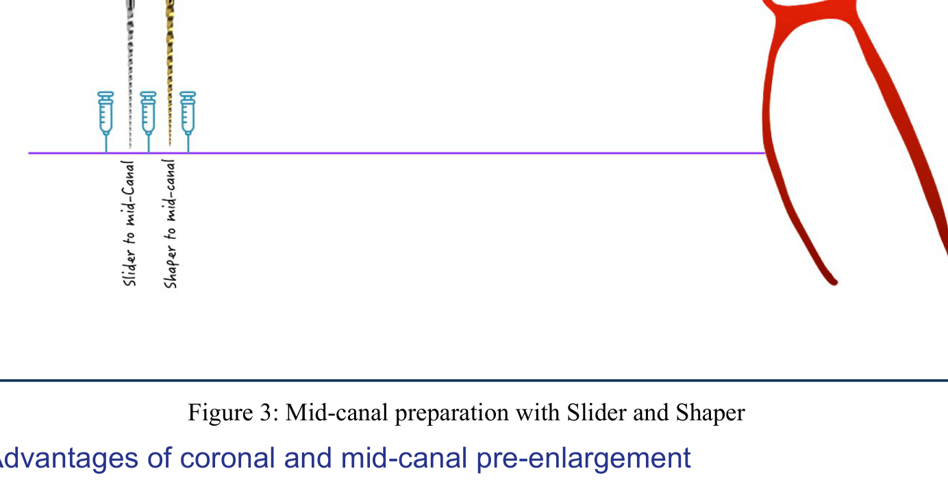 Figure 3: Mid-canal preparation with Slider and Shaper