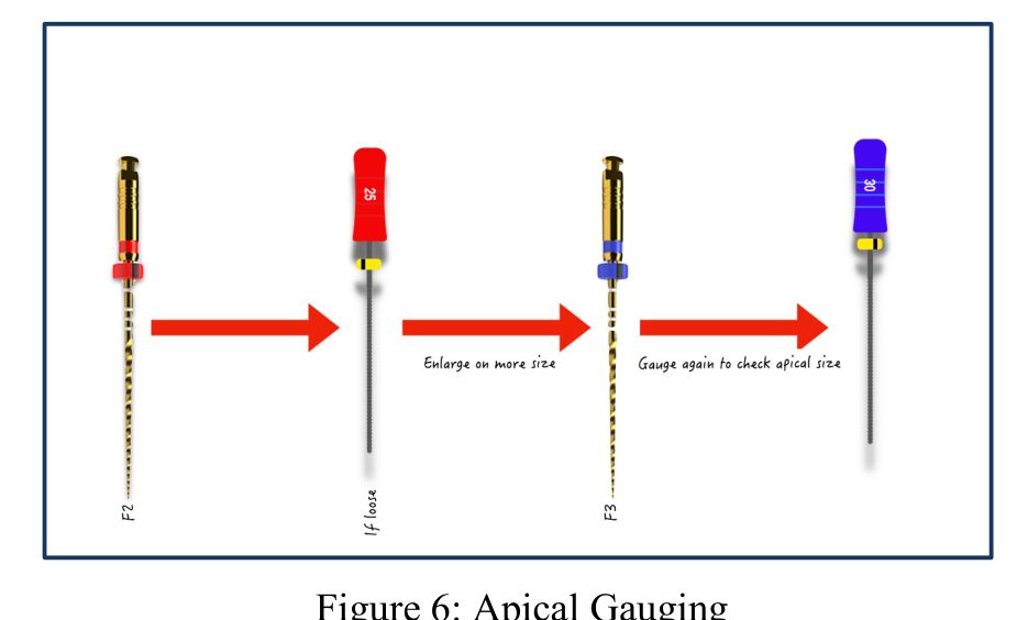 Figure 6: Apical Gauging