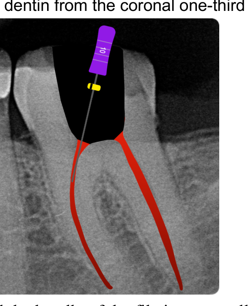 Figure 1: Scouter file deviated, and the handle of the file is not parallel to the long axis of the tooth.