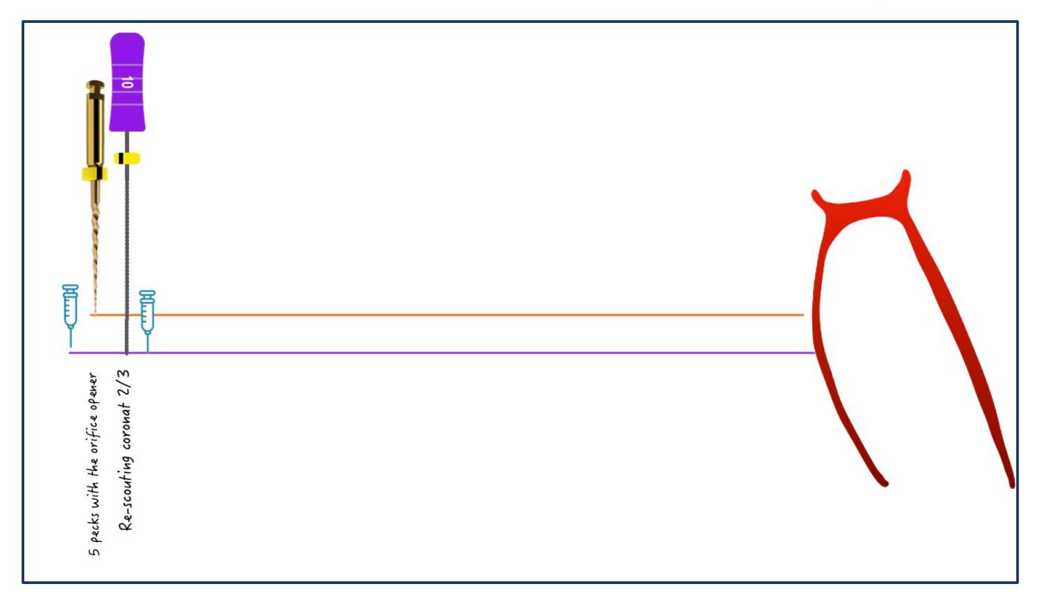 Figure 2: Coronal pre-flaring using an Orifice Opener (SX).